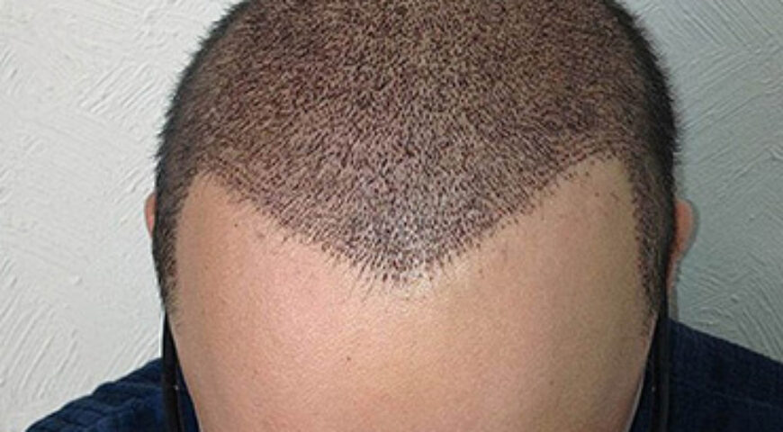 HAIR TRANSPLANTATION